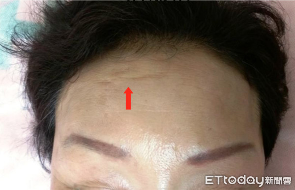 ▲針灸12次撫平抬頭紋　這麼好康？做不到5點馬上長回來。（圖／記者嚴云岑攝）