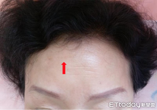 ▲針灸12次撫平抬頭紋　這麼好康？做不到5點馬上長回來。（圖／記者嚴云岑攝）
