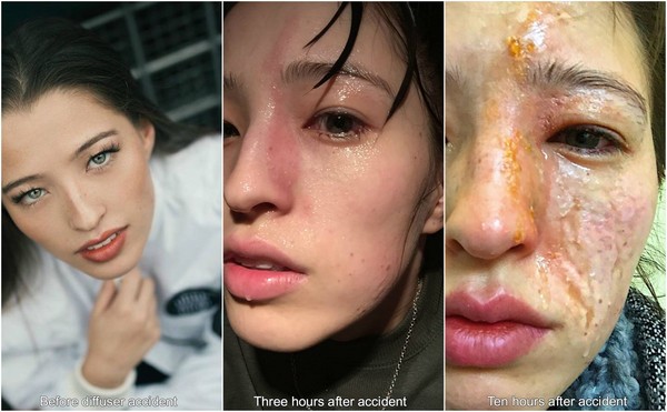 女子脸部溃烂生蛆图片图片