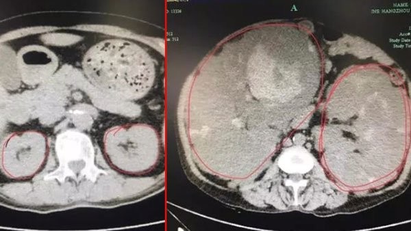 ▲▼浙江杭州一名56歲婦人患多囊性腎臟病，強忍8年導致腎臟長大100倍。（圖／翻攝自浙青網）