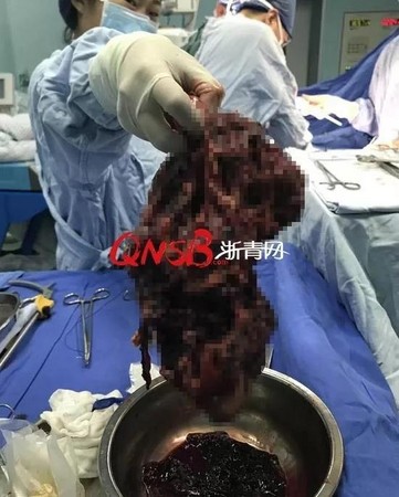 ▲▼浙江杭州一名56歲婦人患多囊性腎臟病，強忍8年導致腎臟長大100倍。（圖／翻攝自浙青網）