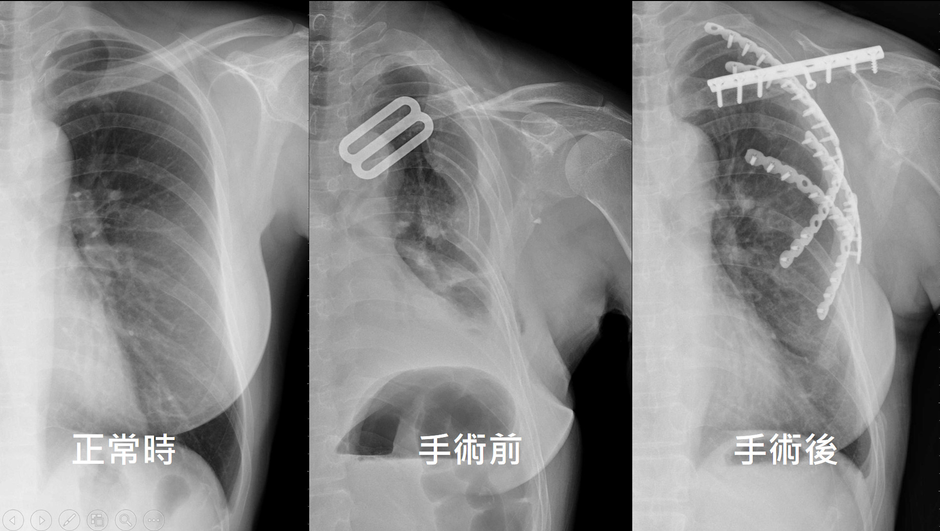 肋骨骨折是呼吸的劇痛固定手術讓患者提早復原 Ettoday生活新聞 Ettoday新聞雲