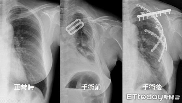 肋骨骨折是呼吸的劇痛固定手術讓患者提早復原 Ettoday生活新聞 Ettoday新聞雲