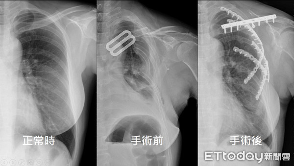 ▲肋骨骨折，治療前後之比較。（圖／記者林悅翻攝）