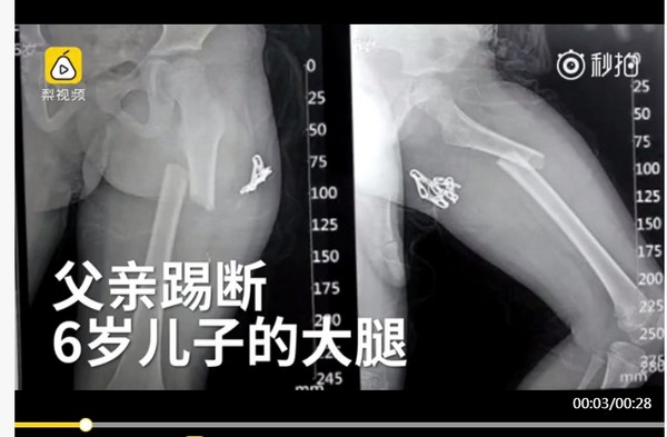 嫌6歲兒走路太慢　暴怒老爸一腳踢斷他大腿。（圖／翻攝自大陸秒拍網站）