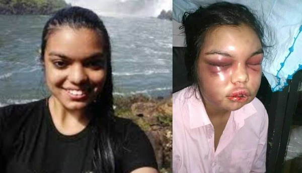 ▲▼ 巴拉圭21歲奧蒂戈薩（Adolfina Camelli Ortigoza）只要臉書照片被按讚，就會被丈夫毒打，最後被打到毀容，如今必須接受鼻中隔與嘴唇的重建手術。（圖／翻攝自Facebook）
