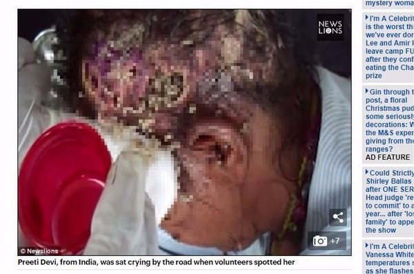▲▼ 印度流浪婦女Preeti Devi頭部遭攻擊受傷，逃至街頭生活，結果引來蒼蠅產卵，滿頭活區亂竄。（圖／翻攝自《每日郵報》）