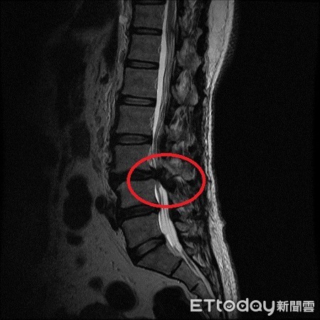高女士的磁振造影顯示神經壓迫嚴重，經脊椎微創手術後第二天即可下床行走，花蓮慈濟醫院神經外科醫師吳聖文對吳女士説明復健衛教。（圖／花蓮慈濟醫院提供）
