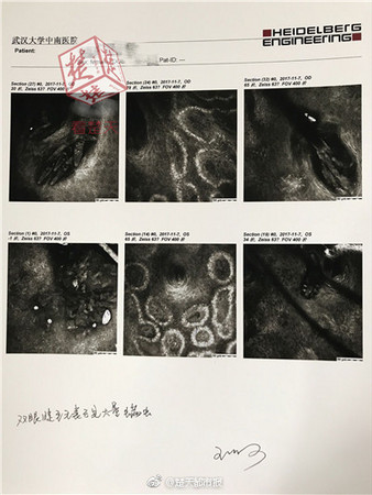 ▲▼枕頭套5年沒洗，大媽睫毛長出上百隻蟎蟲 。（圖／翻攝自《楚天都市報》）