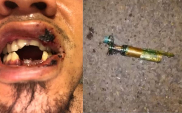 ▲▼ 夏威夷25歲男子使用電子菸時發生爆炸，導致他嘴巴周邊嚴重灼傷，4顆牙齒當場炸飛。（圖／翻攝自Hawaii News Now）