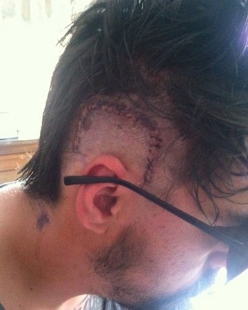 右眼後方像被撞擊！29歲男無預警中風　腦斷層：顱腔全被血填滿。(圖／取自reddit)