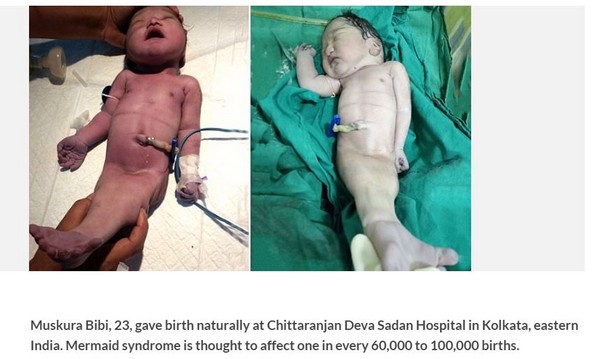 ▲▼ 印度一名母親生下患有美人魚綜合症的寶寶（Sirenomelia），寶寶雙腿融合為一體，只存活4小時即離世。（圖／翻攝自Cetusnews）