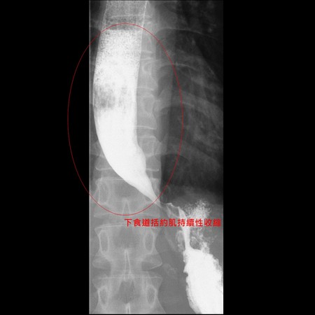 ▲食道弛緩不能症。（圖／亞洲大醫附屬醫院提供）