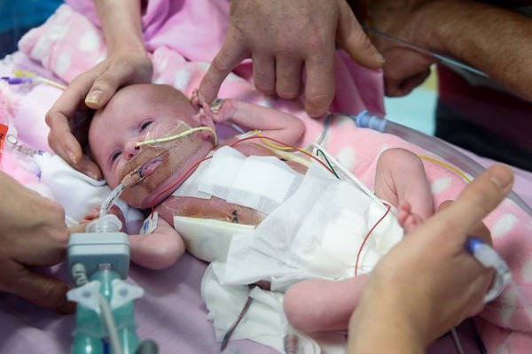 ▲勇敢小生命！女嬰心臟長在外面　3次手術後奇蹟活下來。（圖／翻攝自臉書／Leicester`s Hospitals）
