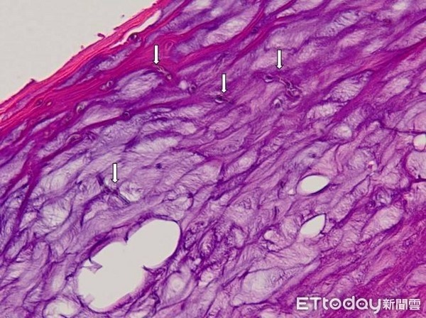 ▲檢查病理組織，可看到角質層有許多淺褐色菌絲。（圖／記者林悅翻攝）