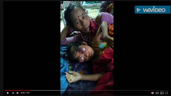 ▲▼印度女童患癌眼球異常凸出。（圖／翻攝自Youtube）