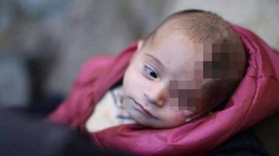 戰火奪走母親跟左眼，上萬網友遮眼，聲援兩月大男嬰