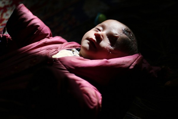 ▲▼ 敘利亞男嬰卡林被戰火波及，左眼失明。（圖／CFP）
