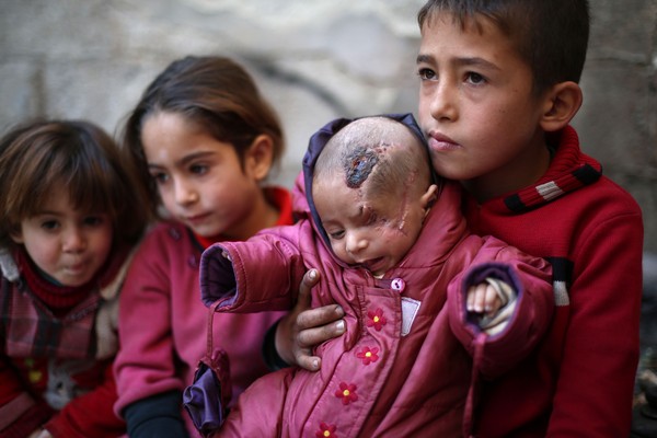 ▲▼ 敘利亞男嬰卡林被戰火波及，左眼失明。（圖／CFP）