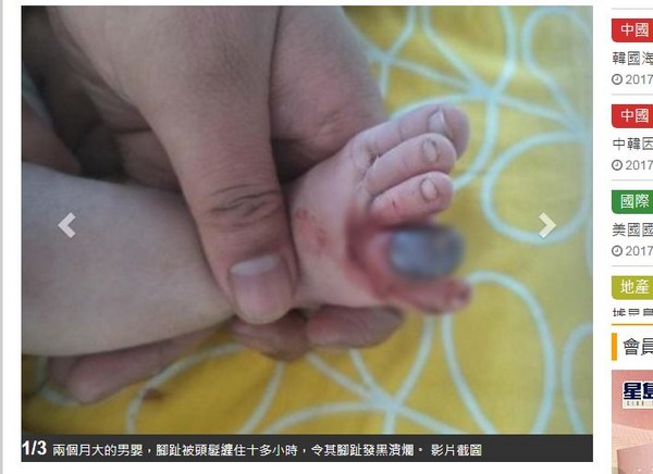 ▲▼ 河南省2個月大男嬰腳趾被頭髮纏住至少10幾個小時，差點截肢。（圖／翻攝自頭條日報）