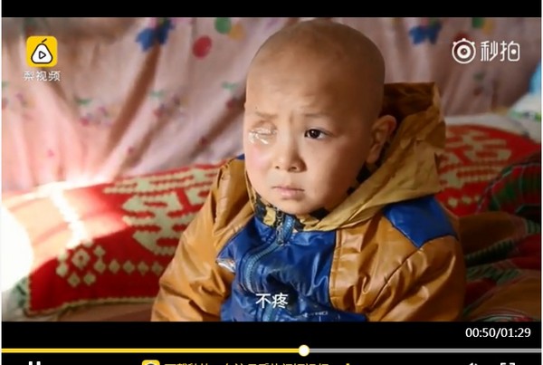 右眼「黑色巨瘤」比臉還大　神仙難救的6歲童變「奇蹟男孩」。（圖／翻攝自大陸《梨視頻》）