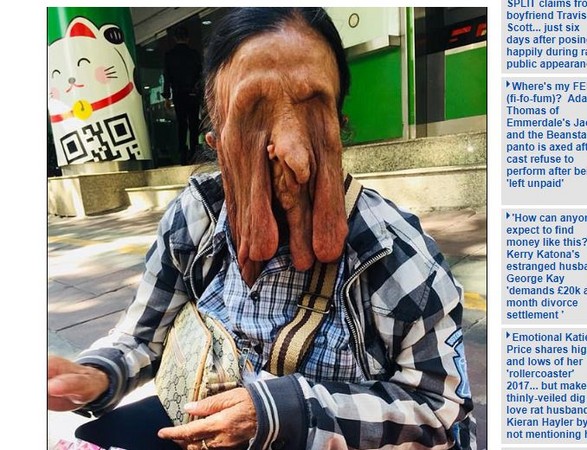 ▲▼ 泰國63歲婦女臉部長出異常組織，但因為害怕死在手術台上、不願動刀，她如今雙眼都看不到，外表看起來就像是皮膚融化一般，眼睛、鼻子、雙頰全都走樣。（圖／翻攝自《每日郵報》）