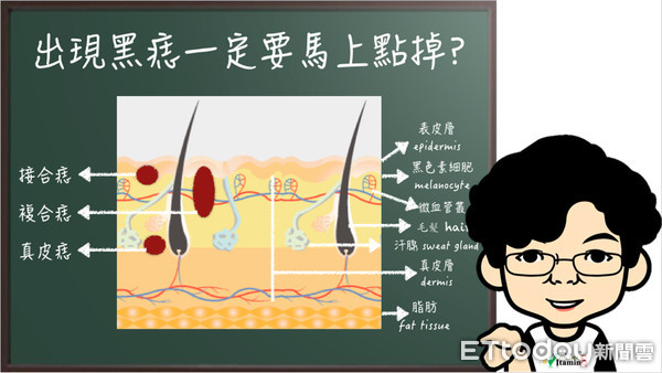 黑痣長毛、顏色不均？別亂點痣！5步驟分別黑色素瘤　