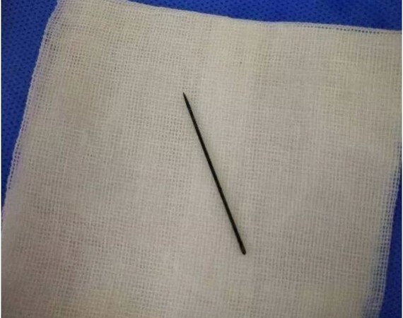痛！12歲童尿道口插3.5公分繡花針　取出發現已生鏽。（圖／翻攝自大陸網站）