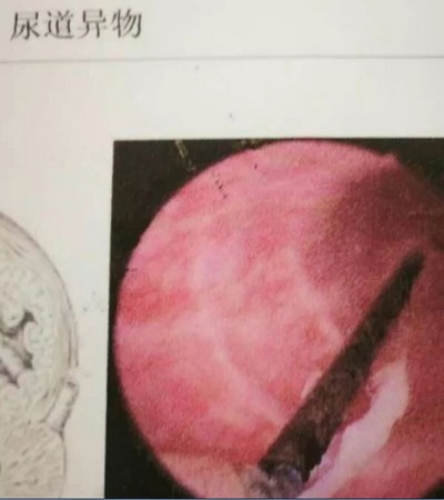 痛！12歲童尿道口插3.5公分繡花針　取出發現已生鏽。（圖／翻攝自大陸網站）