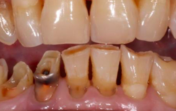 牙齒酸蝕。（圖／醫師提供）