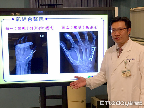 ▲郭綜合醫院骨科洪柏聖醫師，使用微創微型互鎖式骨板，可以提供更穩定的固定、較低的感染率及縮短恢復期等好處，因此成為近年來掌骨骨折治療的新武器。（圖／記者林悅攝）