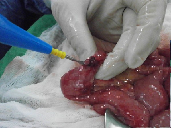 ▲彰化醫院,腸穿孔。（圖／彰化醫院提供）