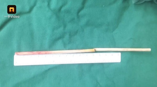 ▲▼2歲男童木筷子插喉嚨,僅差1.5公分穿刺頸。（圖／翻攝自梨視頻）