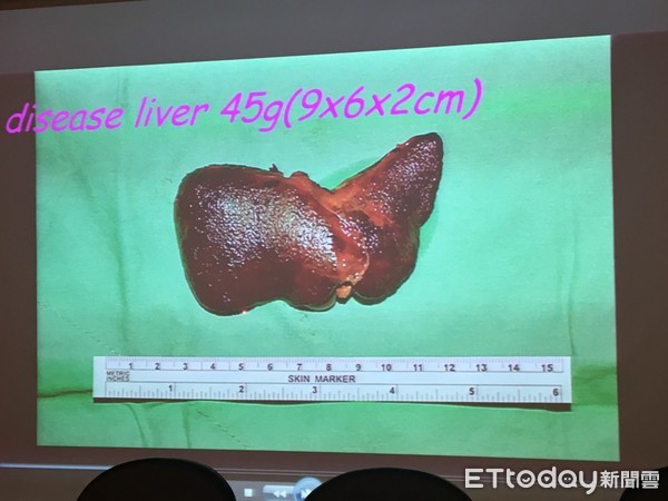 ▲北榮活體單葉肝臟移植。（圖／記者嚴云岑攝）