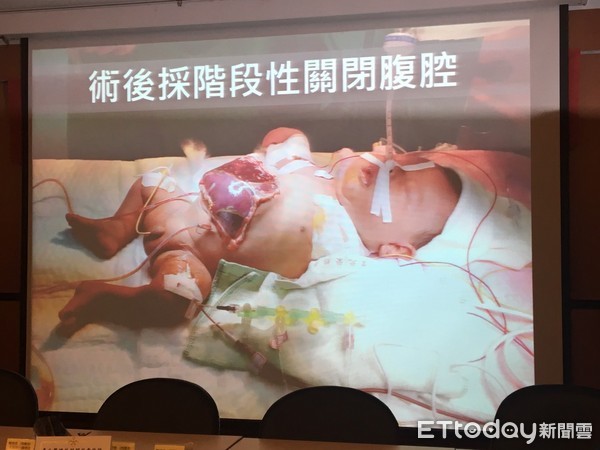 ▲北榮活體單葉肝臟移植。（圖／記者嚴云岑攝）