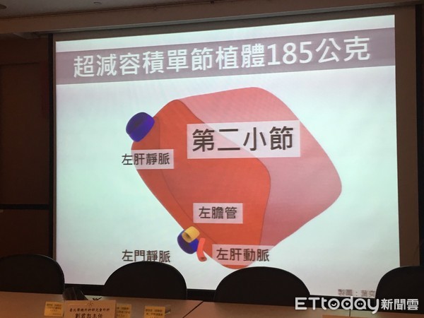 ▲北榮活體單葉肝臟移植。（圖／記者嚴云岑攝）