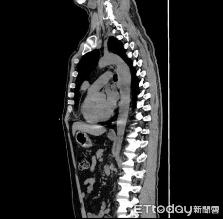 ▲核磁共振顯示患者在前縱隔腔有一腫瘤，約2.7公分。（圖／記者林悅翻攝）