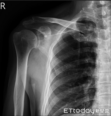 ▲X光顯示在肩胛骨有一蝕骨性病灶。（圖／記者林悅翻攝）