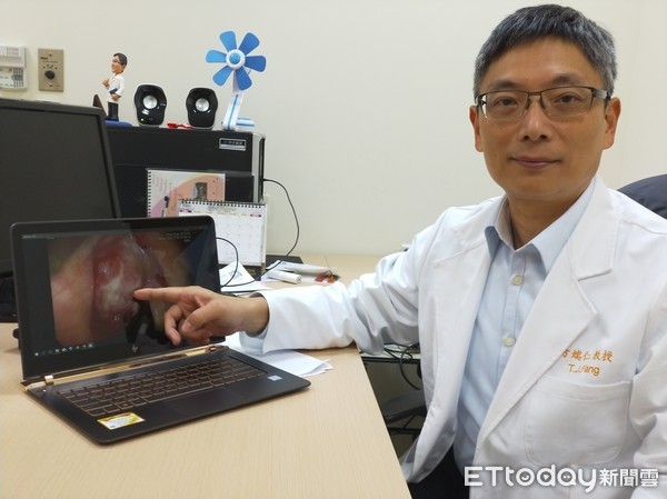 ▲聲音沙啞超過1個月　戒菸30年工程師竟確診「聲門癌」。（圖／長庚醫院提供）