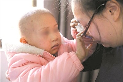 ▲▼廣東東莞一名3歲女童罹患胚胎型橫紋肌肉瘤，壓迫視神經導致右眼失明。（圖／翻攝自廣州日報）