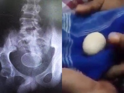 14歲男兩年產卵20次　醫生不信…下體當場再滑出兩顆