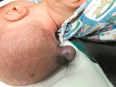 ▲一名出生7天的男嬰，被驚訝發現後腦勺長了一個像如尾指般大小的「小尾巴」! （圖／翻攝自大陸網站）。
