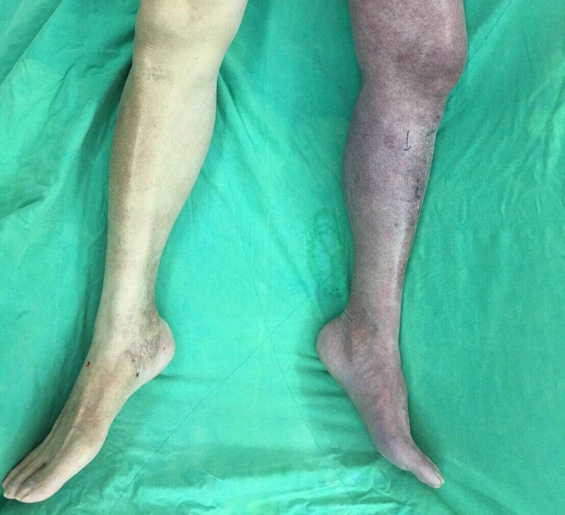 急性靜脈血栓腳發紫高醫 免截肢保命 登國際期刊 Ettoday健康雲 Ettoday新聞雲