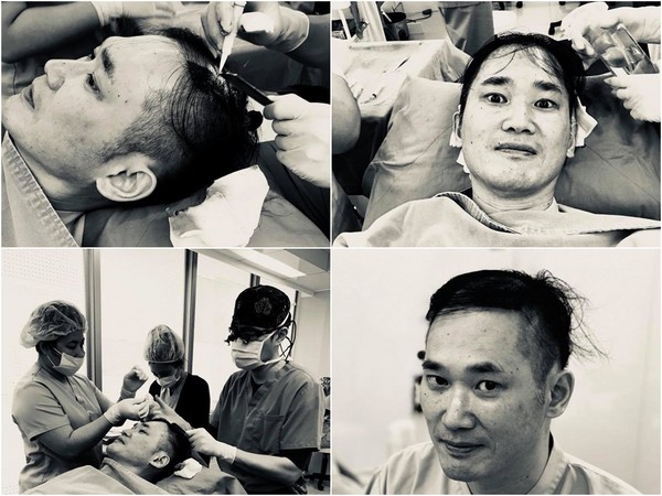 ▲小應將植髮的手術過程PO網。（圖／取自小應臉書）