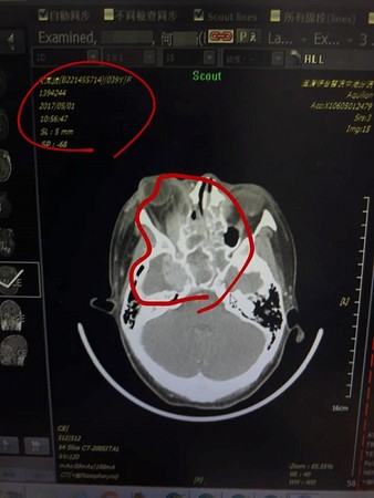 ▲▼姐姐罹癌誤信偏方，一度中斷化療最後在醫院辭世；出殯這天阿嬤含淚白髮人送黑髮人，拿起拐杖緩緩敲打孫女的棺木。（圖／翻攝爆料公社）