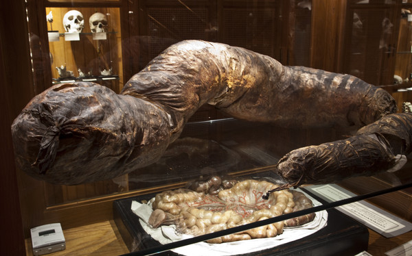 ▲▼世界最大的結腸（圖／翻攝自Mütter Museum）