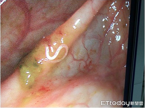 男童露營染鉤蟲！10幾隻蟲藏腸道。（圖／彰基提供）