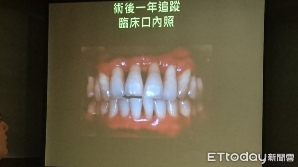 ▲牙周病錯當火氣大！　30多歲男「齒槽骨剩10%」如七旬翁。（圖／記者嚴云岑攝）