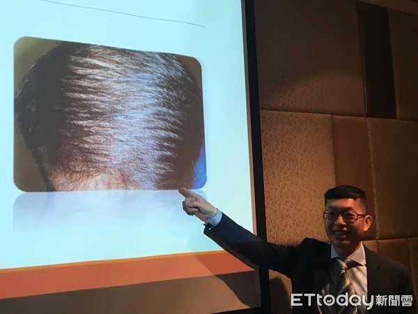 ▲23歲男大生「脫髮5級」　被當中年大叔「面試老碰壁」。（圖／記者嚴云岑攝）