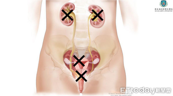 ▲無痛血尿竟確診「尿路上皮癌」　她一次摘7KG器官保命。（圖／記者嚴云岑攝）